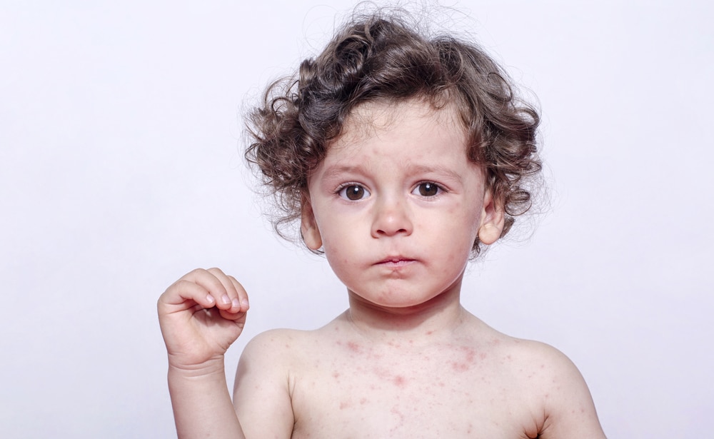 Measles in Children: symptoms and treatment | Baby Arabia