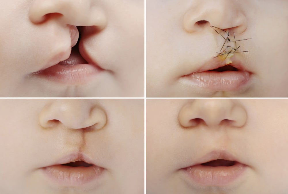 Cleft palate causes, symptoms and treatment Baby Arabia